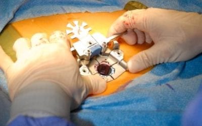 Open Surgery vs Minimal Invasive Surgery