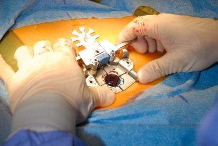 Open Surgery vs Minimal Invasive Surgery