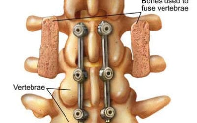 What is Spinal Decompression Surgery?