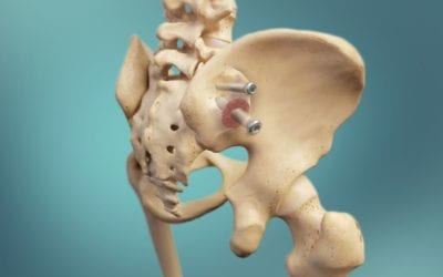 SI Joint Dysfunction: A Common Cause of Low Back Pain