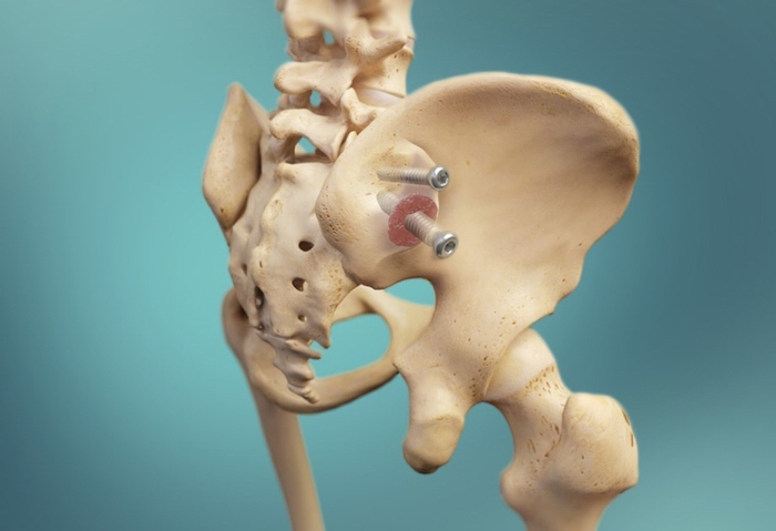 SI Joint Dysfunction: A Common Cause of Low Back Pain